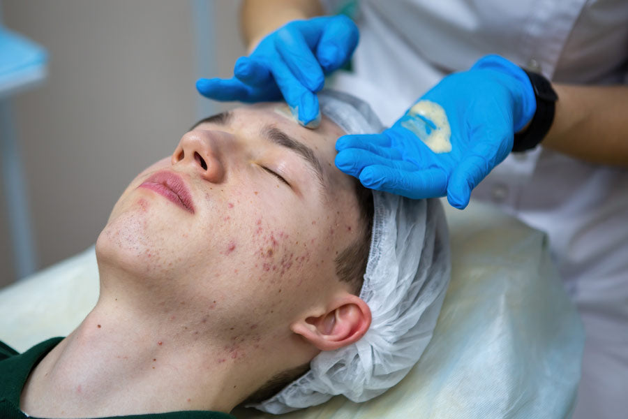 Acne e Cosmetici: Cosa Usare e Cosa Evitare per una Pelle Sana